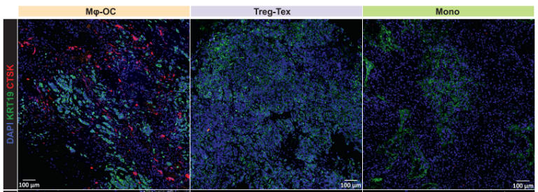 BCM Blog coverage of the bone metastasis heterogeneity study
